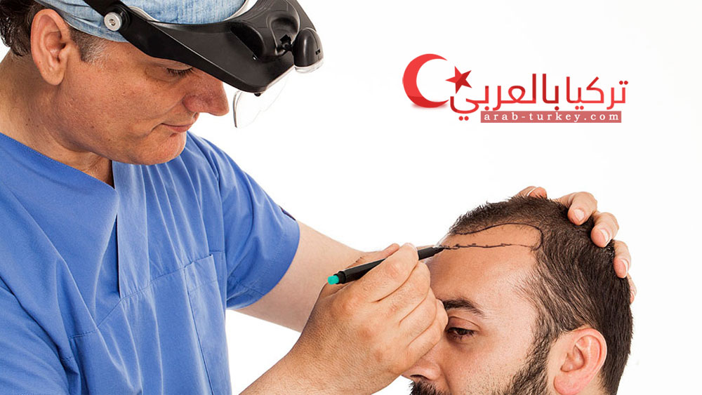زراعة-الشعر