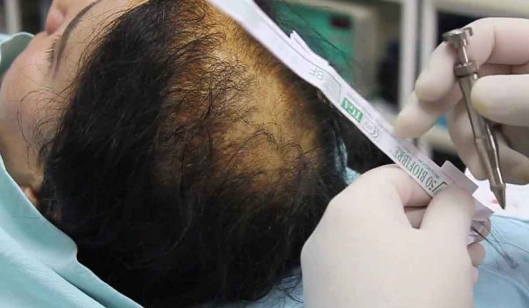 زراعة الشعر