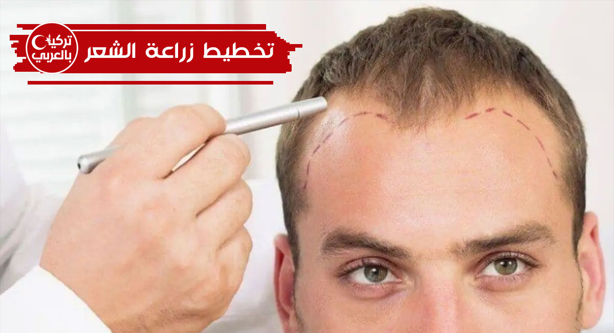 تخطيط زراعة الشعر