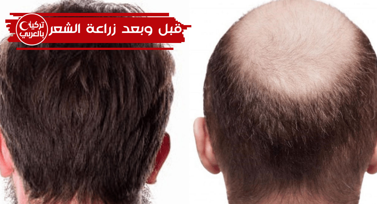 زراعة الشعر