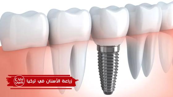 زراعة الاسنان في تركيا